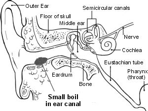 Boil (Furuncle) In The Ear Canal , ENT Consultant London MR Kiran ...