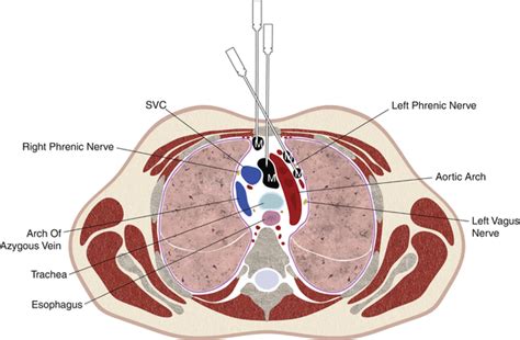 Biopsy of Mediastinal Lesions | Radiology Key