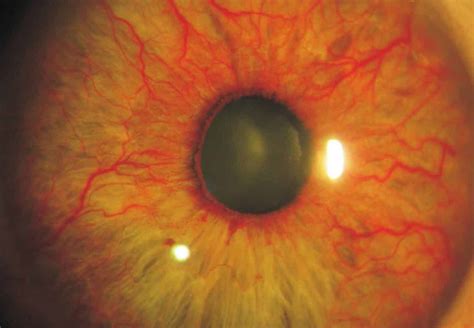 Glaucoma Neovascular: Qué Es y tratamiento Área Oftalmológica