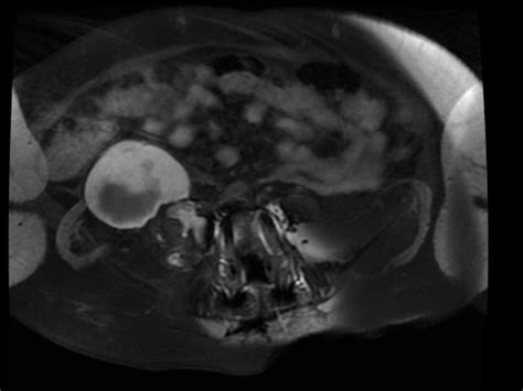 Retroperitoneal Hematoma