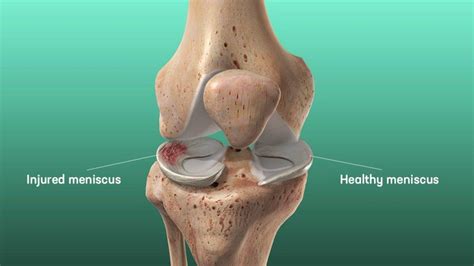 The Complete Guide to a Meniscus Tear - Kinetic Labs | Toronto ...