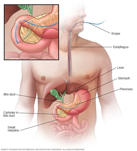 Gallbladder cancer - Diagnosis and treatment - Mayo Clinic