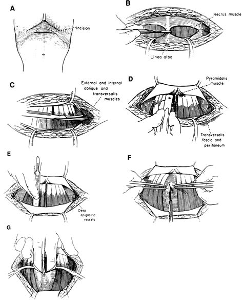 Abdominal wound closure techniques