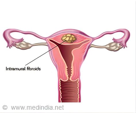 Myomectomy - Indications, Types, Preparation, Procedure & Complications