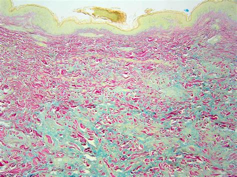 Granuloma Annulare Histopathology