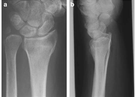 X-ray of a wrist with a distal radius fracture that has healed in ...