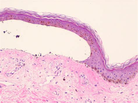 Epidermolysis bullosa acquisita; Epidermolysis Bullosa, Acquired