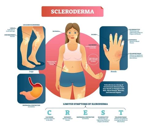 Mixed Connective Tissue Disease: An Autoimmune Overlap Disease - Facty ...