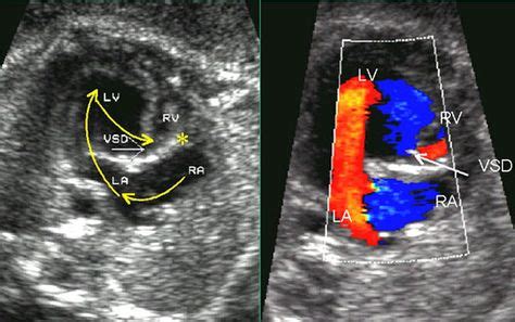 Color Doppler Sonography in assessment of the fetal heart | Ultrasound ...