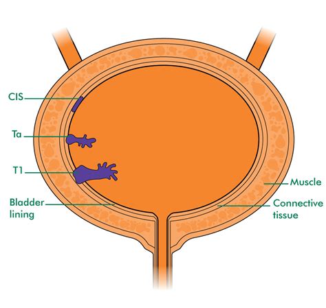 Staging and grading non-invasive bladder cancer - Information and ...