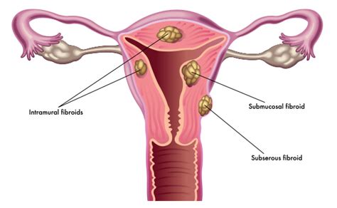 Fibroid Tumors Information & Types | Fibroid Treatment Collective