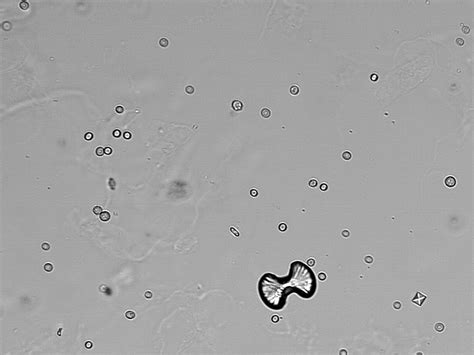 File:Calcium oxalate crystals (urine) - kalsiyum oksalat kristalleri ...