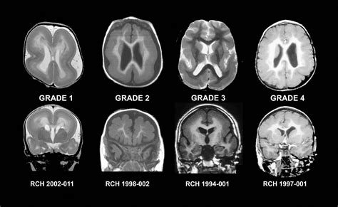 Abnormal Brain MRI | Mri Scan Images | Mri, Brain scan, Mri scan