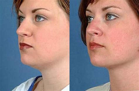 Neck Procedures Before & After Photo Gallery | Louisville, KY | CaloSpa ...