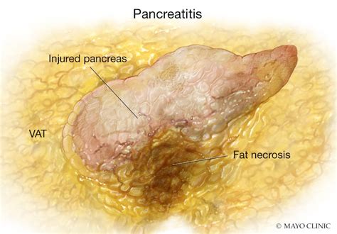 Examining the role of visceral fat in worsening inflammation, organ ...