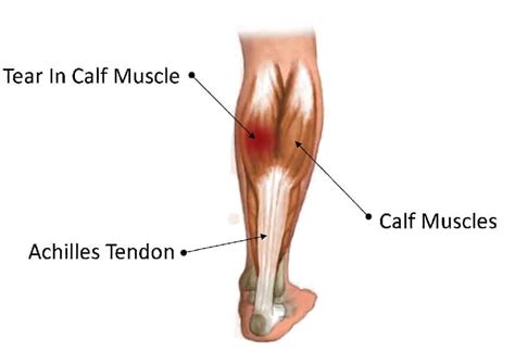 Calf muscle pain cause and treatment with exercises for relief