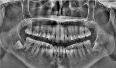 Eruption Cyst Radiography