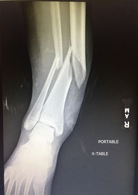 Tibia And Fibula Fractures Ankle | Images and Photos finder