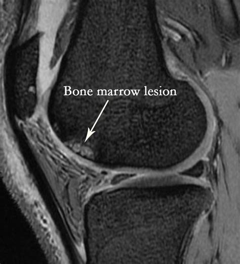 MRI of knee osteoarthritis showing bone marrow lesion. | Download ...