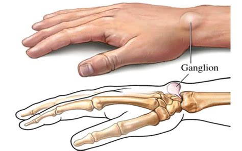 Ganglion Cyst - Mississauga And Milton Chiropractor and Physiotherapy ...