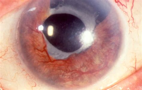 Neovascular glaucoma - American Academy of Ophthalmology