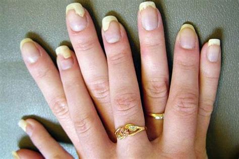 Fingernail Fungus Causes Treatment - Nail Ftempo