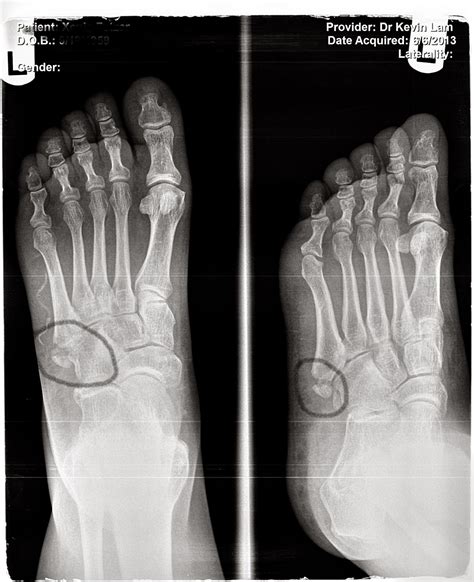 Dr. K. Lam Straight Talk: Foot Fractures more common during "ankle ...