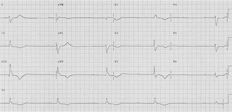 AV block: 3rd degree (complete heart block) • LITFL • ECG Library