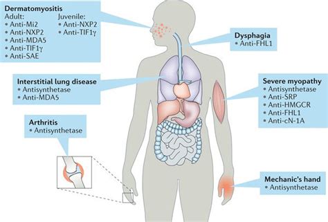 What is Myositis? - Myositis Support and Understanding