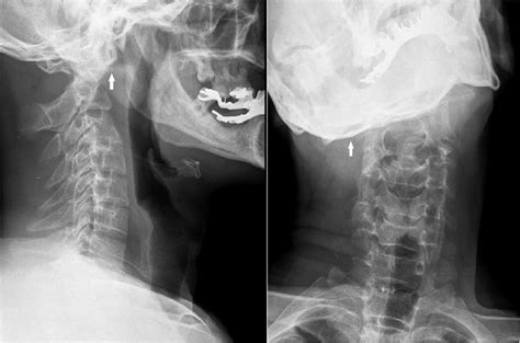 Abnormal Cervical Spine Mri