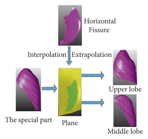 Pulmonary lobe separation. (a) Right complete oblique fissure surface ...