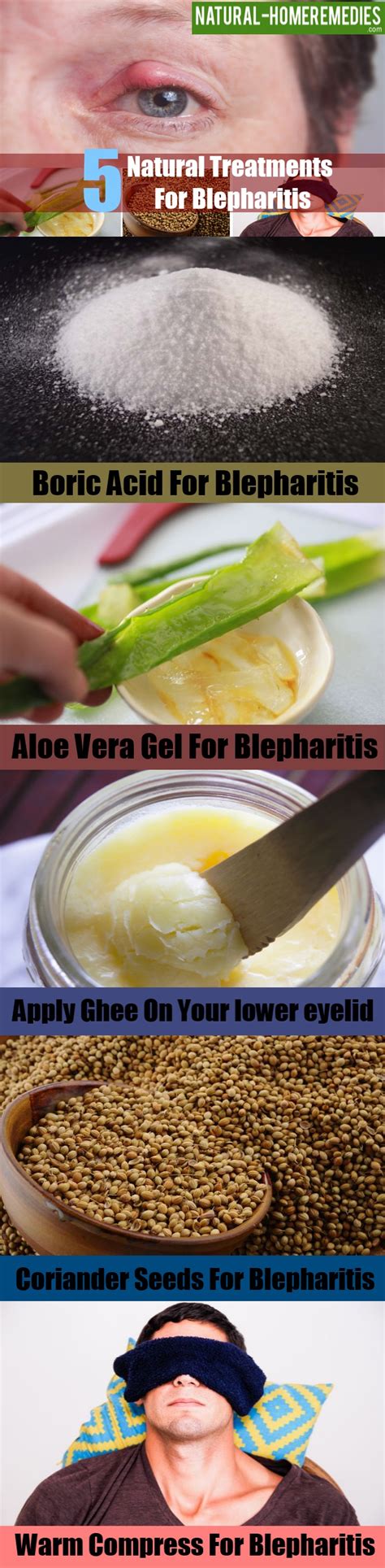 5 Natural Cures For Blepharitis – Natural Home Remedies & Supplements