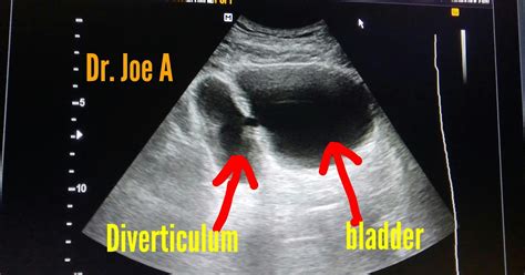 Ultrasound imaging: Urinary-bladder-Diverticulum-3D ultrasound