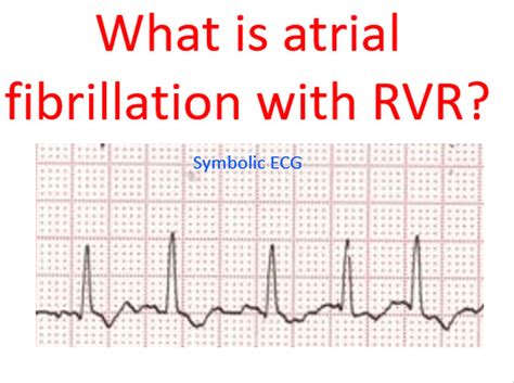 What is atrial fibrillation with RVR? - All About Heart And Blood Vessels