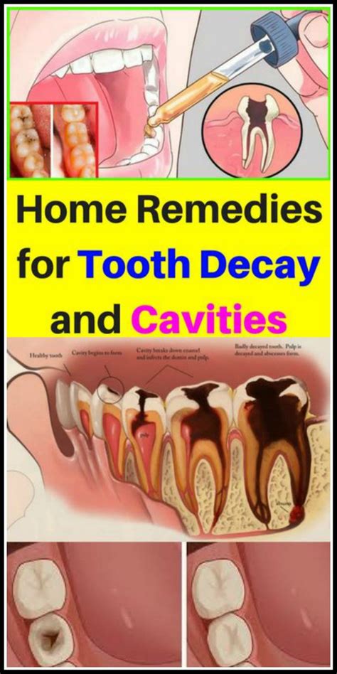 Home Remedies For Tooth Decay & Cavities!!! | Teeth rotting, Tooth ...