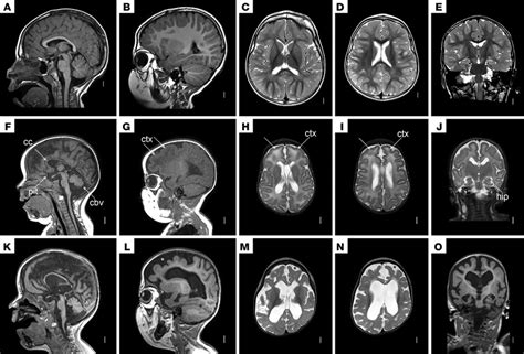 MRI scan images of patient NM720. Brain MRI in a normal 3-year-old ...