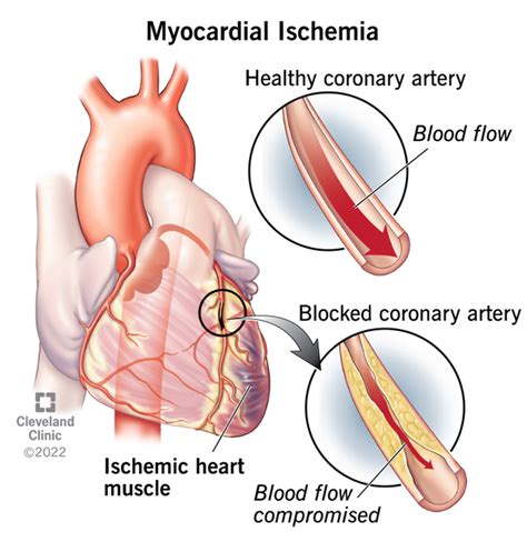 Myocardial Ischemia: Causes, Symptoms and Treatment