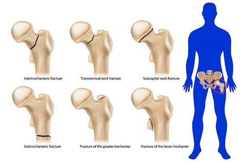 Breaking Down Hip Pain: Understanding the Causes and Treatment Options ...