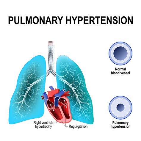 Know Pulmonary Artery Hypertension Symptoms, and Treatment | Dr Raghu