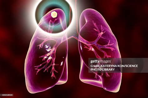 Treatment And Prevention Of Tuberculosis Conceptual Illustr High-Res ...