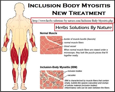 Inclusion Body Myositis New Treatment - Herbs Solutions By Nature