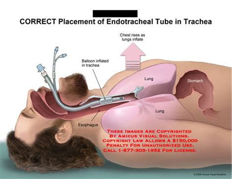 AMICUS Illustration of amicus,medical,endotracheal,tube,trachea,balloon ...