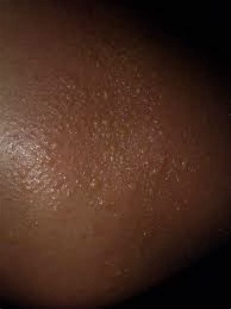 Heat Bumps On Black Skin