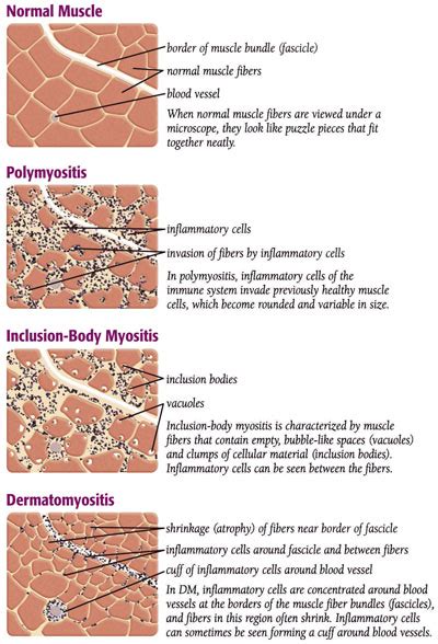 What is Myositis? - Myositis Support and Understanding