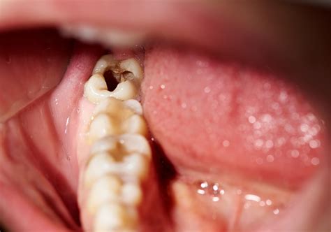 Dead tooth: Symptoms, causes, and treatment