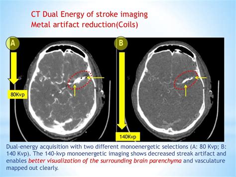 CT scan of the brain in stroke patients