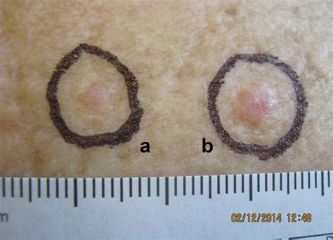 RACGP - Early detection and non-invasive diagnosis of basal cell ...