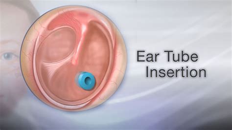 HIE Multimedia - Ear tube insertion