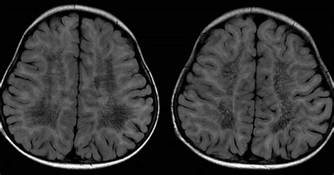 Radshare: METACHROMATIC LEUKODYSTROPHY