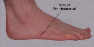 Side Of Foot Pain: **Diagnosis & Home Treatment**